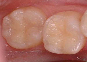Two teeth with composite fillings