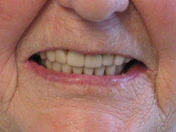 A close up shot of a patients implants