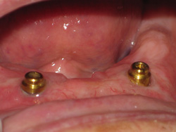 A close up shot of implant anchors in a patients gums