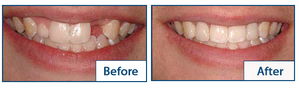 A before and after comparison of a patients smile with implants