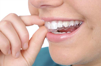 Person putting on an invisalign tray