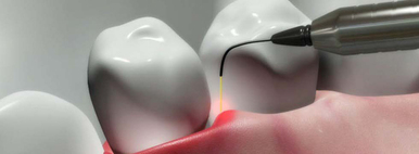 Soft tissue diode laser being used on gums