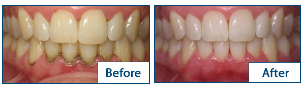 A before and after comparison of teeth and gums undergoing periodontal therapy