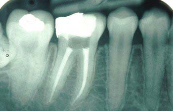 X-ray of teeth showing a root canal