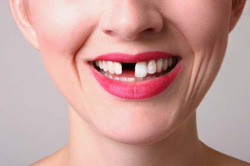 A woman smiling with a front tooth missing
