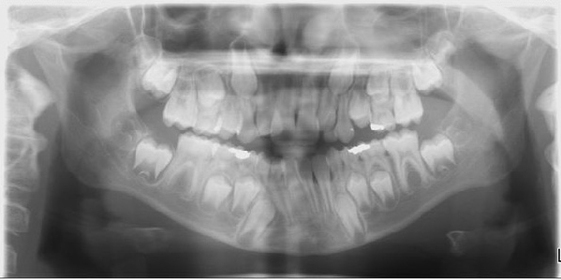 Dental X-ray